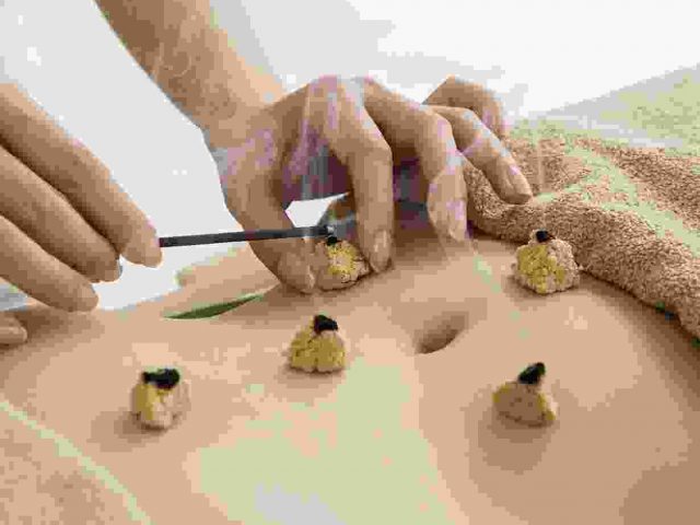 Moxibustion